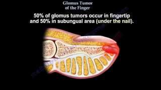 Glomus Tumor Of The Finger  Everything You Need To Know  Dr Nabil Ebraheim [upl. by Clute]