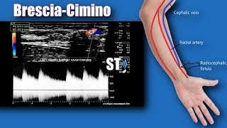 Sonoquickies  Hemodialysis Vascular Access Ultrasound [upl. by Auhsohey549]