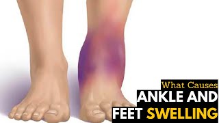 What Causes Ankles amp Feet Swelling  Diagnosis amp Treatment [upl. by Kathlin]