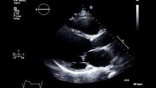 Ischemic Cardiomyopathy 2D Echocardiogram [upl. by Eusassilem]