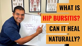 Top 3 Steps For Treating Hip Bursitis [upl. by Farrish]