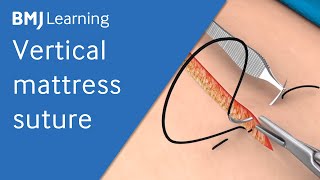 Vertical Mattress Suture  BMJ Learning [upl. by Aelem]