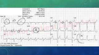 EKG befunden leicht gemacht EKG Beispiele [upl. by Merilyn]