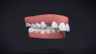 Invisalign® Treatment with Manidublar Advancement [upl. by Alisun]