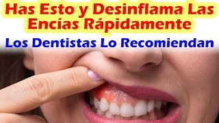 Como Desinflamar Las Encías Rápidamente Con Remedios Para Las Encías Recomendados Por Dentistas [upl. by Rramed]