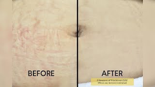 Pregnancy Stretch Marks Removal Treatment in Delhi  Care Well Medical Centre [upl. by Ettenirt366]