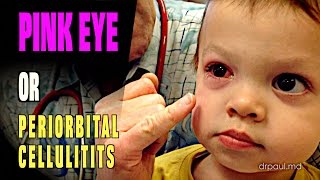 LIVE DIAGNOSIS Pink Eye or Periorbital Cellulitis  Dr Paul [upl. by Dollie565]