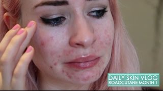 Roaccutane Daily Skin Vlog  Month 1 [upl. by Asatan]