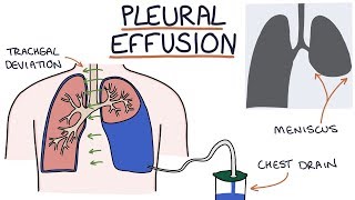 Understanding Pleural Effusions [upl. by Stephana]