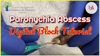 Finger Paronychia Emergency amp Digital Block Tutorial [upl. by Rozanna]