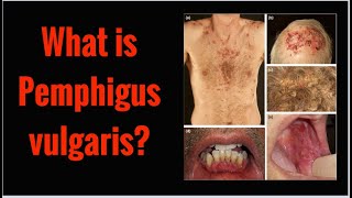 What is PEMPHIGUS VULGARIS Symptoms Causes [upl. by Lodmilla938]