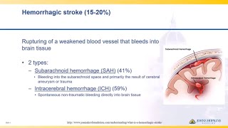 Pontine stroke syndromes [upl. by Dulce]