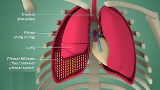 Pleural effusion  Internal medicine Etiology Clinical Features Diagnosis and Treatment Usmle [upl. by Erodoeht]