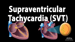 Supraventricular Tachycardia SVT PSVT Animation [upl. by Nerra840]