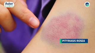 Dr Srinivasa Munivenkatappa talks about Pityriasis Rosea [upl. by Llertram850]