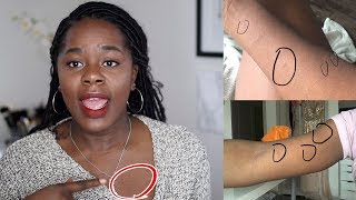 My Skin Story  How I got rid of Pityriasis Rosea  TheAdeTomi [upl. by Esinert]