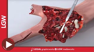 Right Hand Fracture Animated Surgery Recreation [upl. by Sheila]