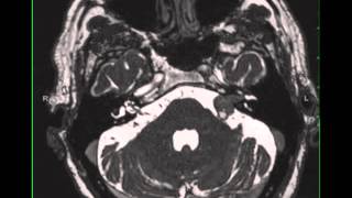 Spinal Tumor Whats [upl. by Taylor359]