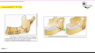 Mandibular Fractures  Part 2 MANAGEMENT [upl. by Attinahs]