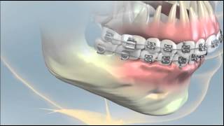 Orthognathic Surgery NYC [upl. by Kursh]