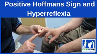 Positive Hoffmans Sign and Hyperreflexia [upl. by Yras]