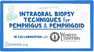 Intraoral Biopsy Techniques for Pemphigus amp Pemphigoid in Collaboration w Western University [upl. by Annahs706]