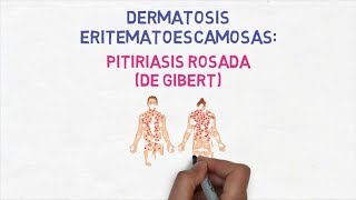 Dermatología  Pitiriasis Rosada de Gibert o de Gilbert [upl. by Roux10]