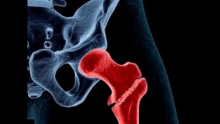 Treating Osteoporosis or Low Bone Density [upl. by Alcot]