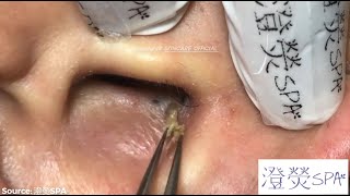 Giant Ear Acne Removal Blackheads  How To REMOVE BLACKHEADS  Part 1 [upl. by Margit]