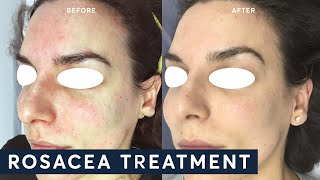 Treating Rosacea with IPL [upl. by Zebaj]