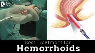 Laser Hemorrhoidoplasty vs Open Hemorrhoidectomy  Hemorrhoid Treatment  Dr Rajasekhar M R [upl. by Nemzzaj]