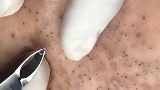 Pulling Out Lots Of Blackheads 😱 [upl. by Enrobialc587]