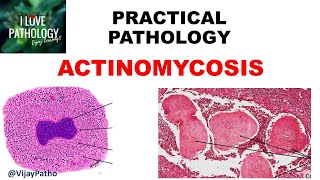 Practical Pathology ACTINOMYCOSIS [upl. by Leuname49]