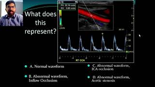 Secrets of Carotid Ultrasound [upl. by Candyce482]