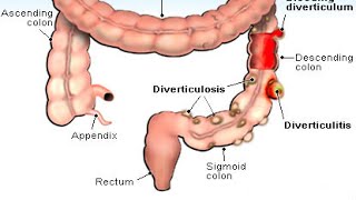 Diverticulitis [upl. by Scibert266]