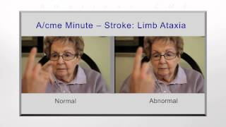 Stroke limb ataxia [upl. by Ycrep]