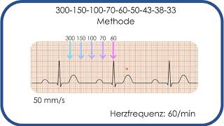 EKGBefundung Herzfrequenz in Sekunden bestimmen 300150100Methode [upl. by Gilford]