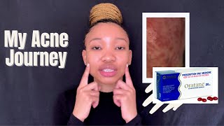 Is OrataneAccutane the cure to Acne The side effects and My Acne Journey [upl. by Adella]