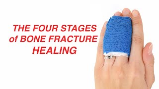 The Four Stages of Bone Fracture Healing [upl. by Scevo]