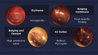 What Is Tympanic Membrane Perforation [upl. by Imtiaz67]