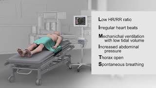 POCUS Cardiac IVC Change with fluids [upl. by Donahoe]