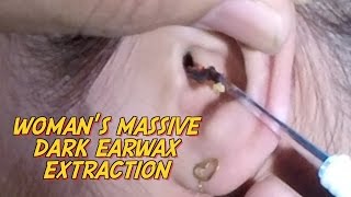 Womans Massive Dark Earwax Extraction [upl. by Aryn682]