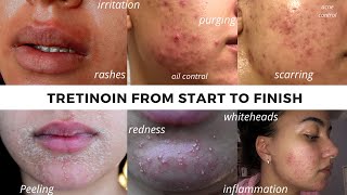 TRETINOIN BEFORE AND AFTER  FULL TRETINOIN EXPERIENCE my journey from start to end Adult Acne [upl. by Esyahc858]