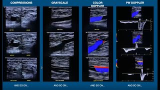 POCUS  Visually Estimating Cardiac Function [upl. by Esimaj308]