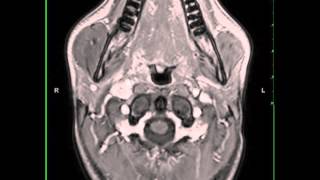 Acoustic Neuroma  3D Virtual Tour  UCLA Neurosurgery [upl. by Ianthe277]