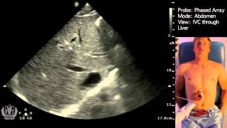 Ultrasound Estimated PostVoid Residual Bladder [upl. by Sol]