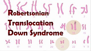 Robertsonian Translocation Down Syndrome ROB [upl. by Nahsyar453]