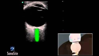 How to Ocular Ultrasound 3D Video [upl. by Esoranna]