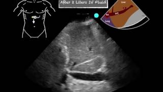 A childs guide to hospital IVC in Medical Imaging [upl. by Giraud]