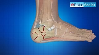 Surgical Treatment for Calcaneus Fracture or Broken Heel Its Types [upl. by Morvin]